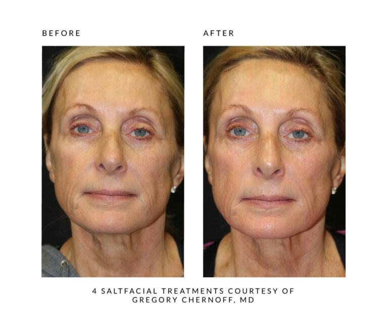 The SaltFacial® Skin Renewal Therapy Treatment By SaltMED