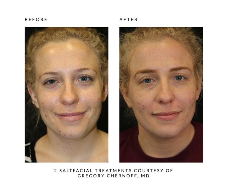 The SaltFacial® Skin Renewal Therapy Treatment By SaltMED