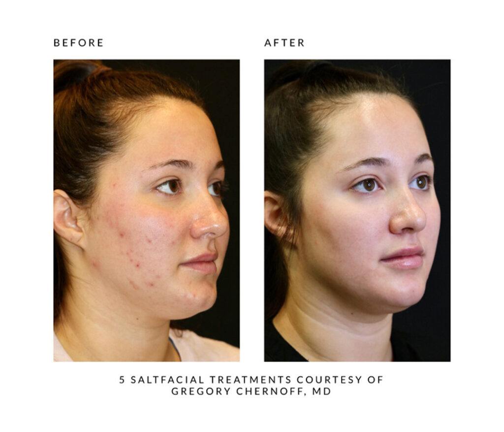 The SaltFacial® Skin Renewal Therapy Treatment By SaltMED