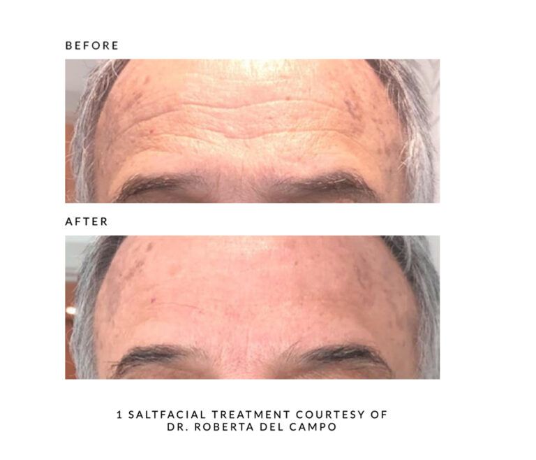 The SaltFacial® | Skin Renewal Therapy Treatment By SaltMED