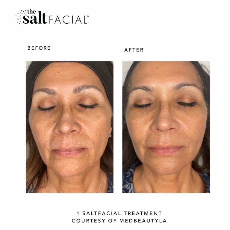 The SaltFacial® | Skin Renewal Therapy Treatment By SaltMED