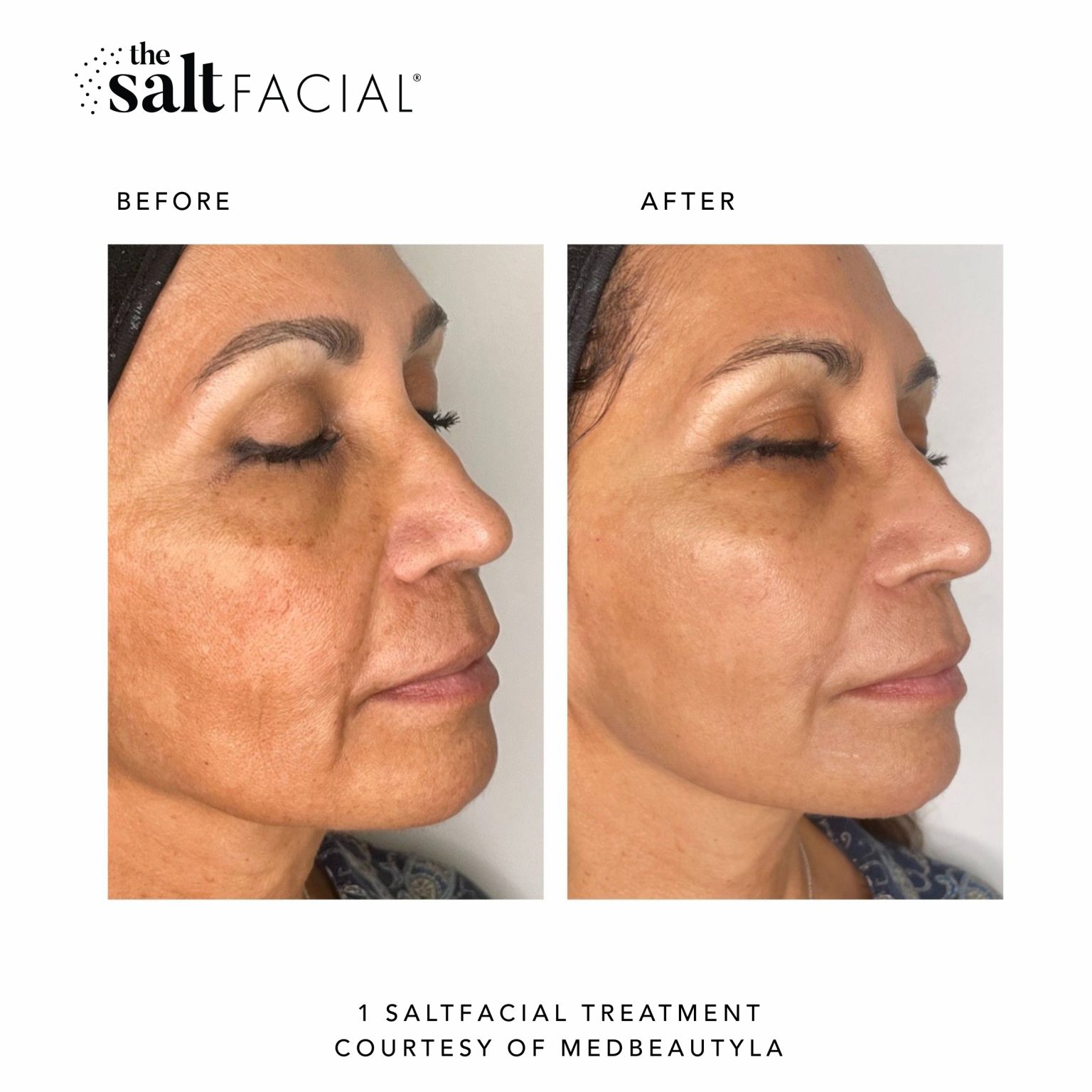 The SaltFacial® | Skin Renewal Therapy Treatment By SaltMED