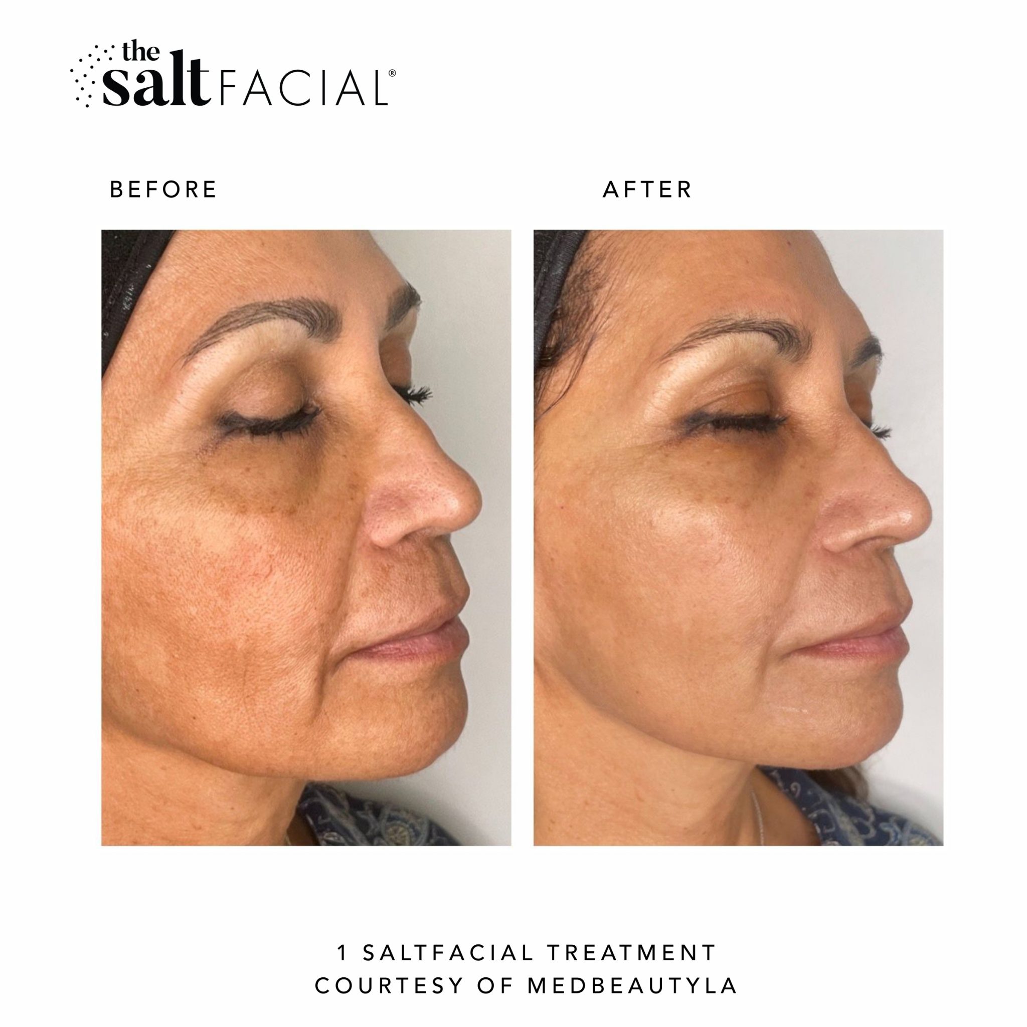 The Salt Facial Skin Renewal Therapy Treatment By SaltMed